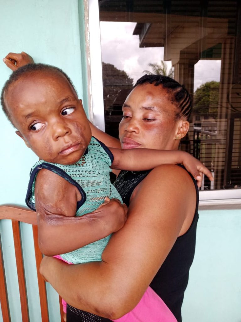 How Kerosene Explosion Burnt One-Year-Old Girl in Calabar