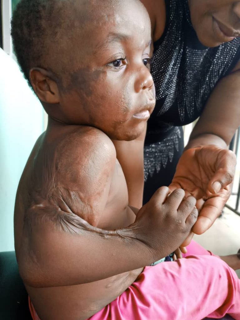 How Kerosene Explosion Burnt One-Year-Old Girl in Calabar