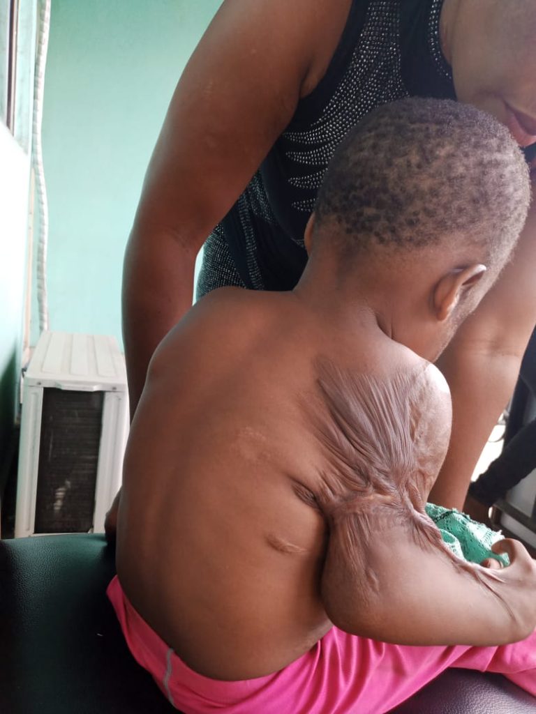 How Kerosene Explosion Burnt One-Year-Old Girl in Calabar