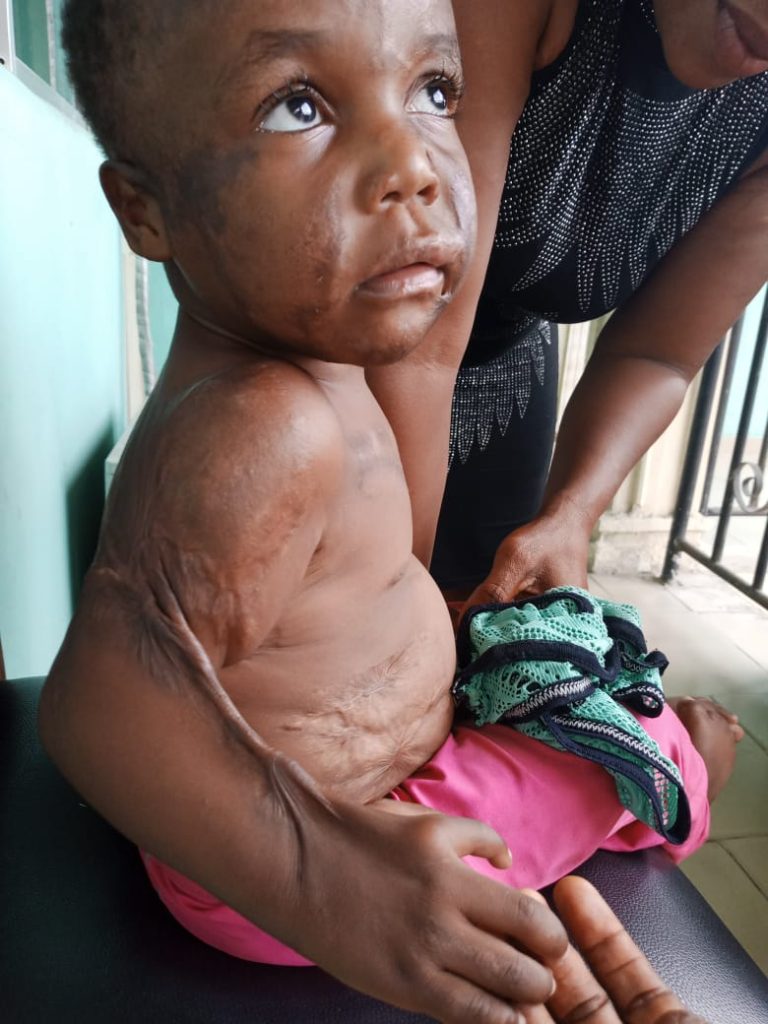 How Kerosene Explosion Burnt One-Year-Old Girl in Calabar