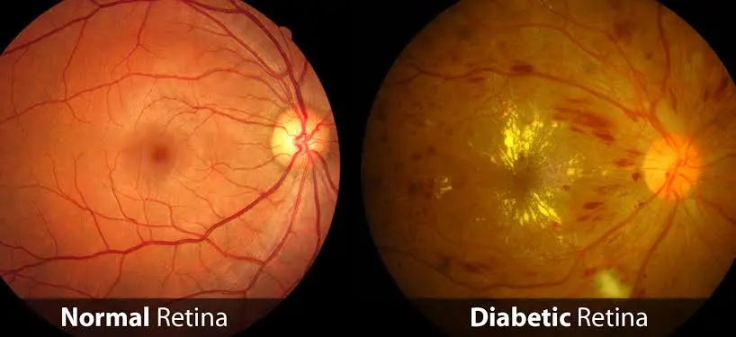 About 1.2 Million Nigerians Are Suffering From Diabetic Retinopathy - Ophthalmologist