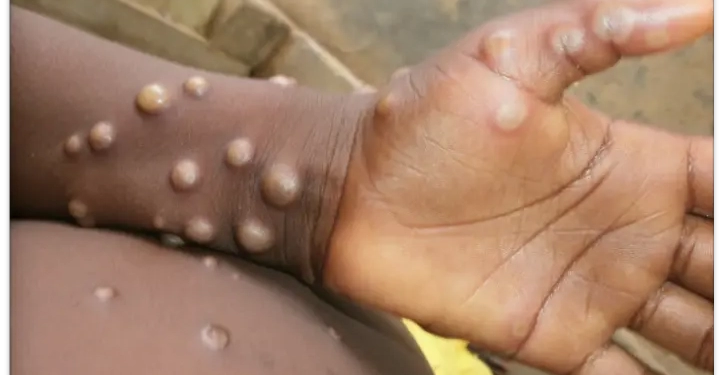 Ayuk debunks NCDC's claim of monkeypox in Cross River