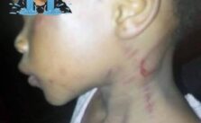 Mother Allegedly Beats Daughter for Not Knowing How to Count in Ondo State, Leaving Her with Welts (Photos)
