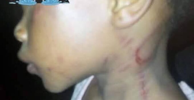 Mother Allegedly Beats Daughter for Not Knowing How to Count in Ondo State, Leaving Her with Welts (Photos)