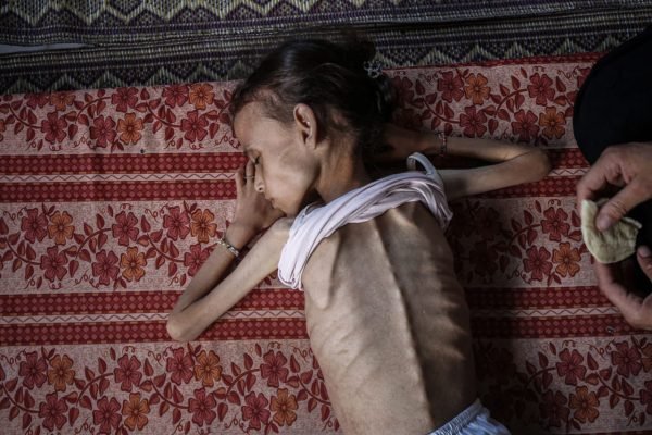 Palestinian 9 years old girl Maryam Abdulaziz Mahmoud Davvas German Chancellery wary of plans to treat children from Gaza, Israel